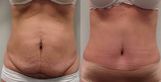 Trim that tummy! 5 important things to know about tummy tuck